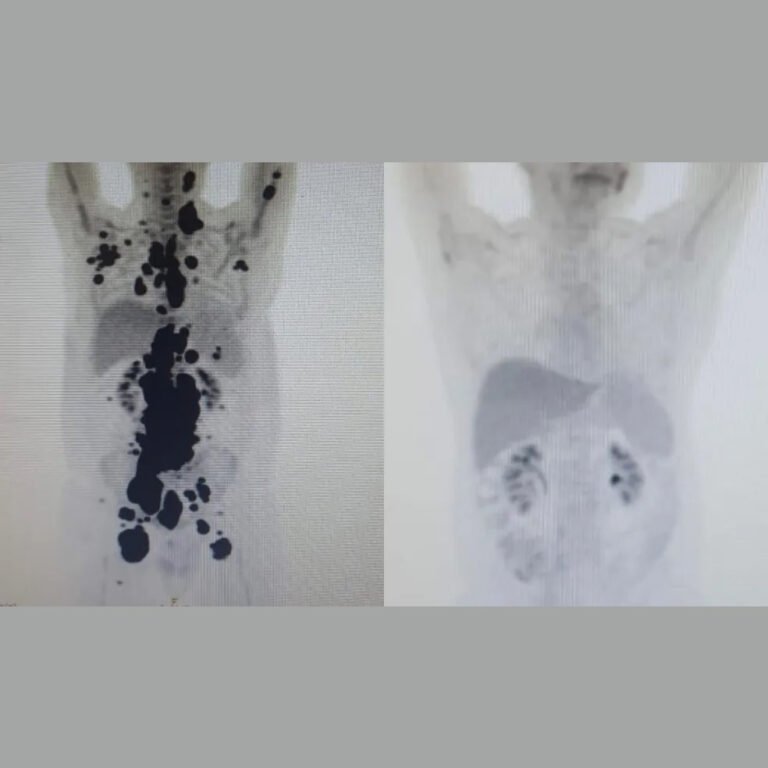 Terapia CAR-T Cell desenvolvida pela USP mostrou redução significativa do linfoma não Hodgkin em 9 de cada 10 pacientes, segundo estudo divulgado em 09/06/2026.
